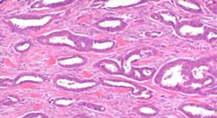 Breast cancer stem cell